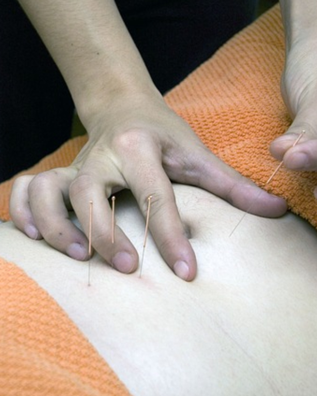 acupuncture